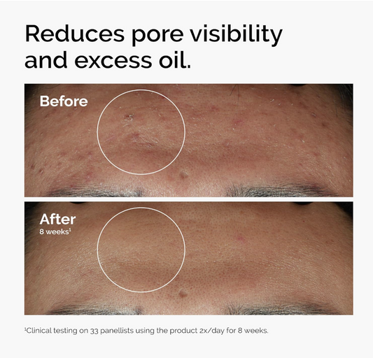 The Ordinary Niacinamide 10% + Zinc 1% – Suero Facial para Imperfecciones y Poros Visibles